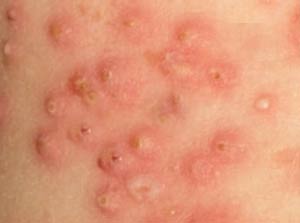 Impetigo